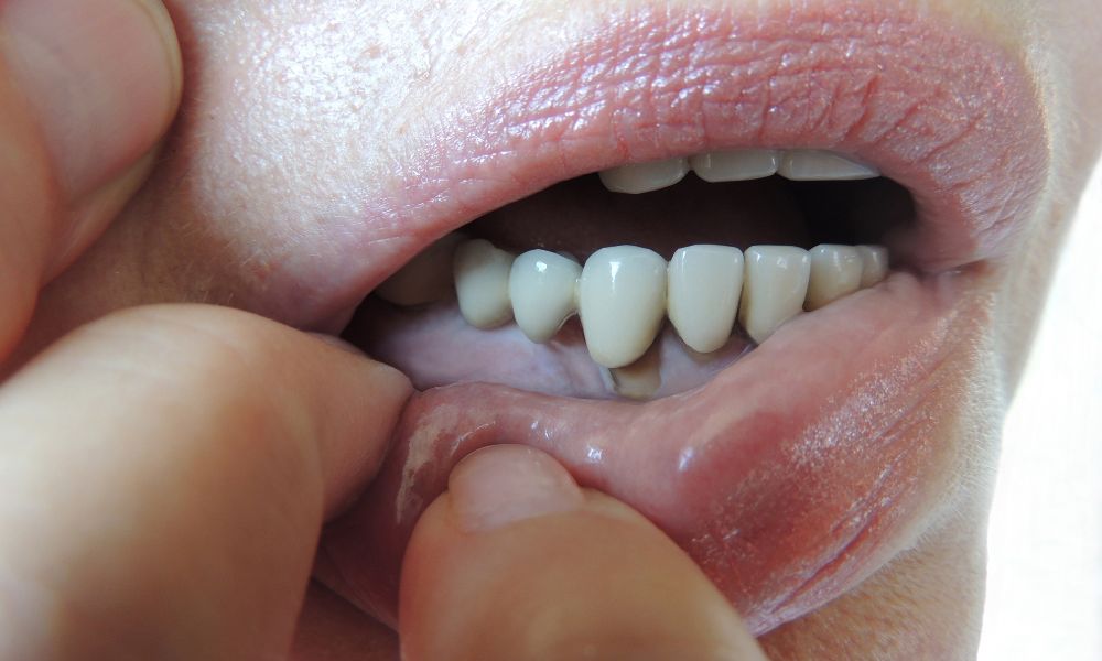 What are the symptoms of periodontitis