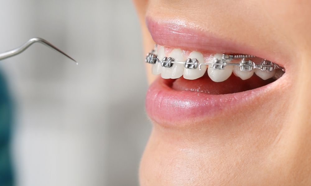 Mantenimiento a largo plazo de la salud dental después de la ortodoncia<br />
