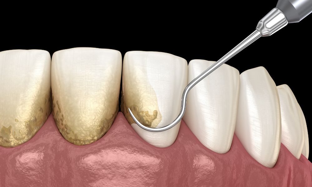Tratamientos para la Periodontitis