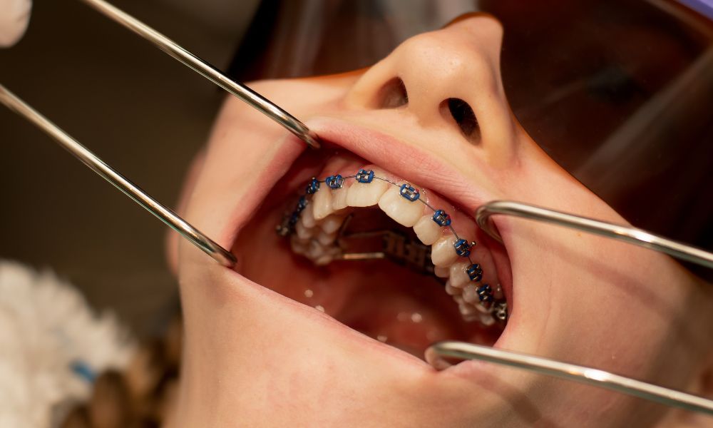 Beneficios del Uso del Expansor de Paladar<br />
