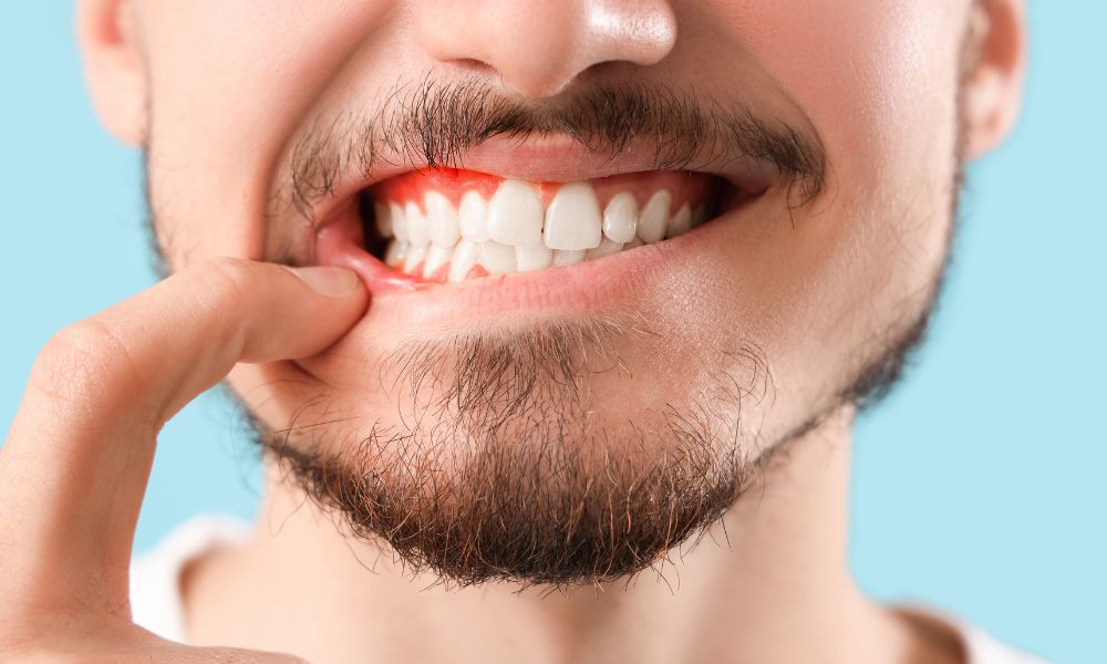 Diagnóstico de la Inflamación de las Encías<br />
