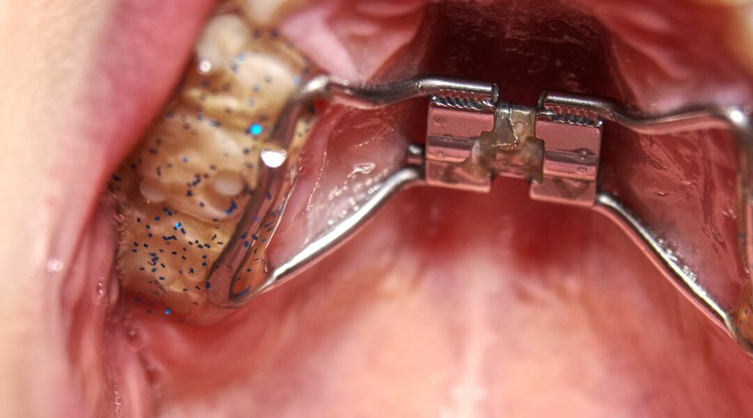 Palate Expander What is it and what is it for?