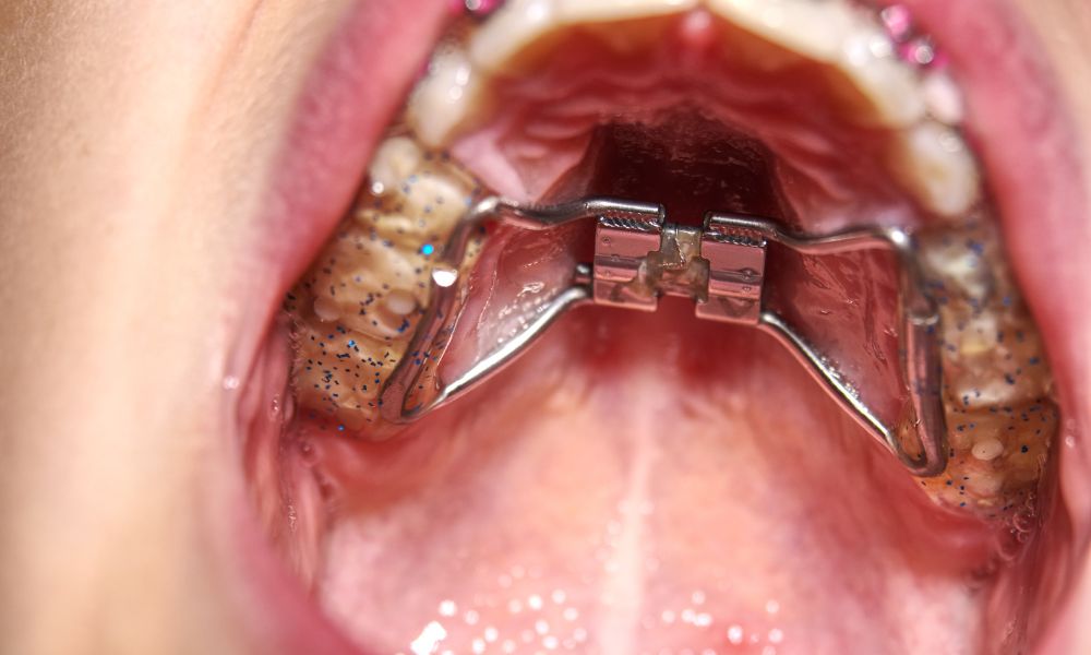 Indications for the Use of a Palate Expander