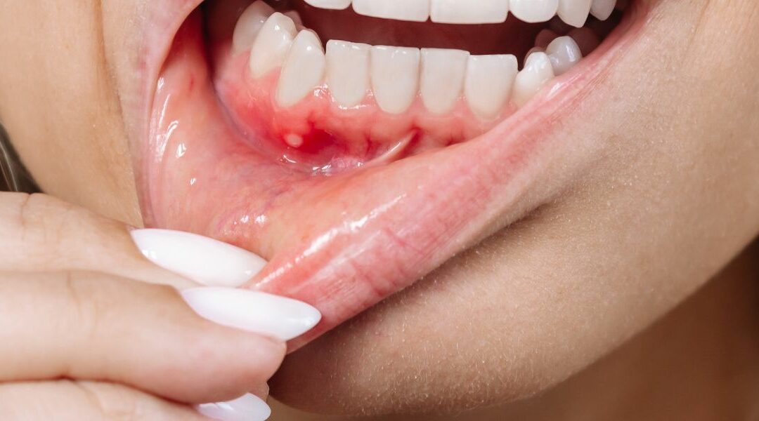 Gum Inflammation: Causes, Symptoms and Treatments