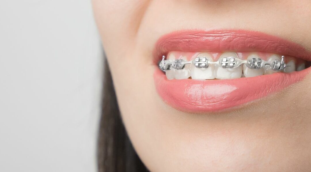 Ligas de los Brackets ¿sabes para qué sirven?