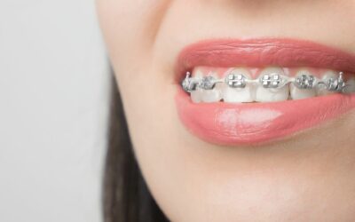 Ligas de los Brackets ¿sabes para qué sirven?