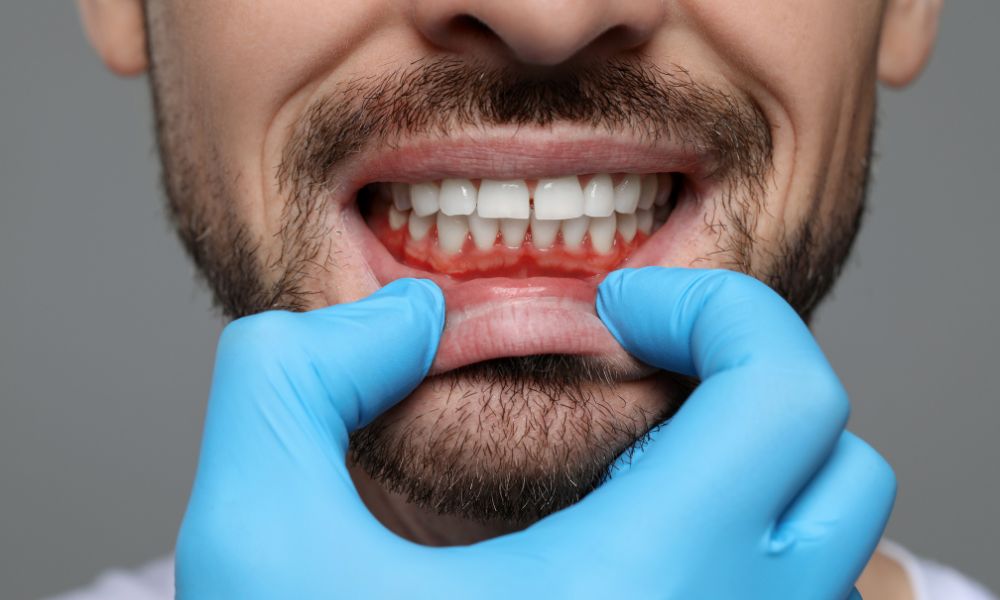 Síntomas de la Inflamación de las Encías<br />
