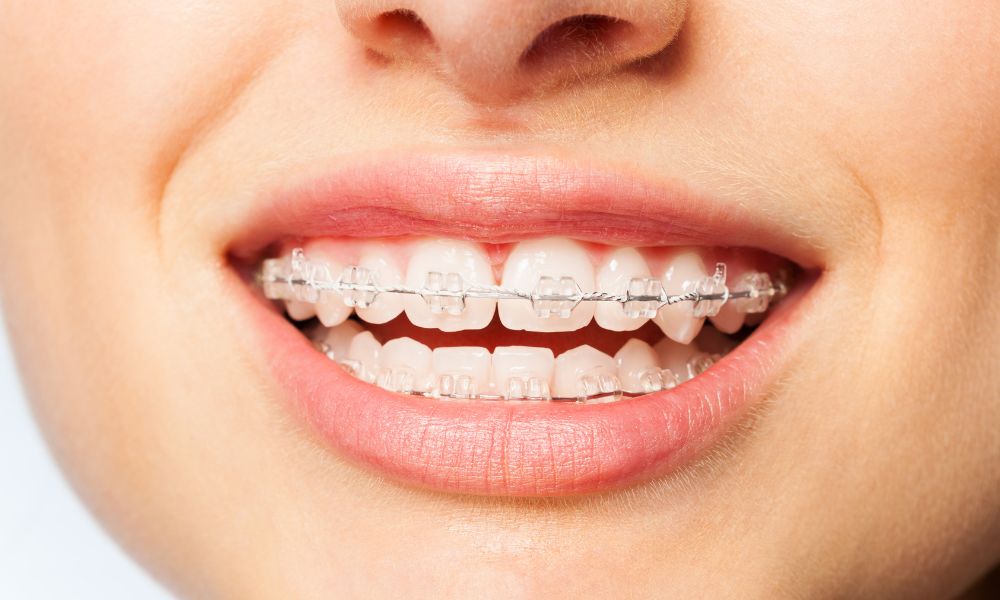 Tipos de Ligas para Brackets