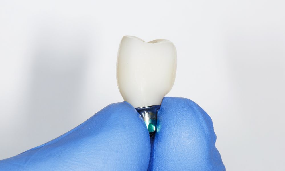 Circunstancias en las que se puede limar una corona de zirconio