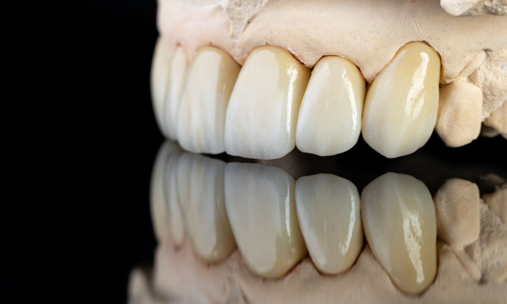 Coronas De Zirconio: Conozca Sus Desventajas 2 Coronas de Zirconio Desventajas