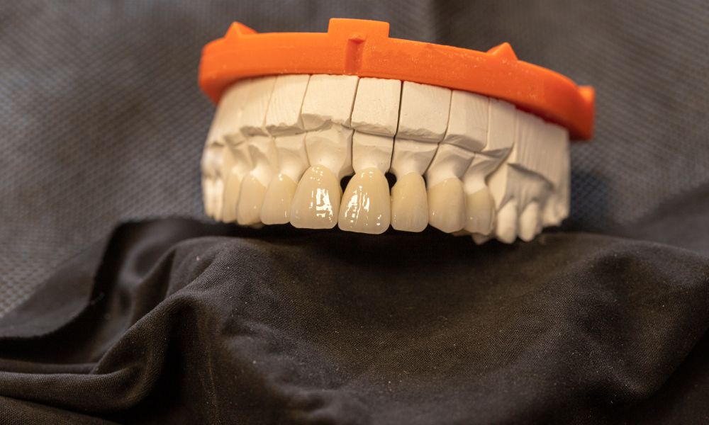 Coronas De Zirconio: Conozca Sus Desventajas 1 Introducción a las Coronas de Zirconio