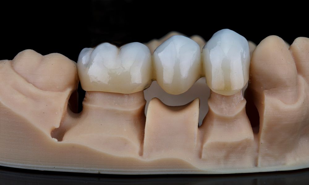 Técnicas y herramientas para el ajuste de coronas dentales de zirconio