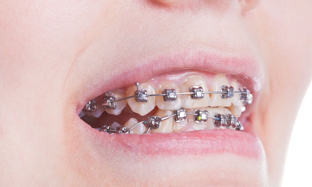Descubre Los Beneficios De Brackets Autoligables 1 Innovaciones en ortodoncia: brackets autoligables