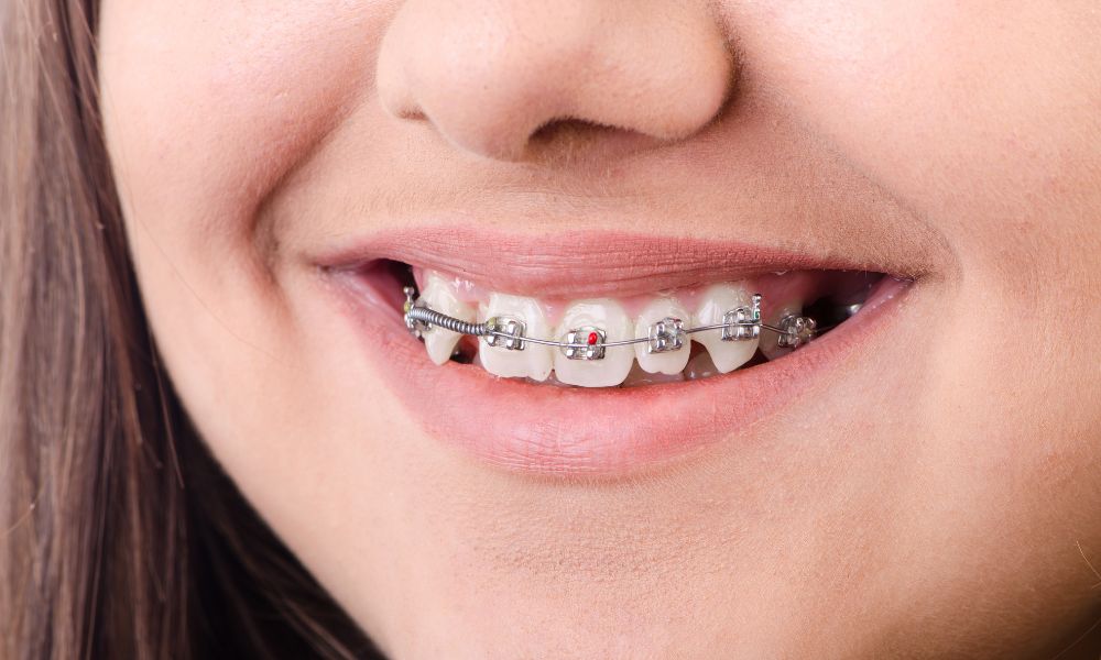 Descubre Los Beneficios De Brackets Autoligables 2 Los Brackets Autoligables: Combina Estética y Comodidad