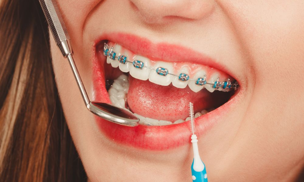 Alternativas A Los Brackets Para Una Sonrisa Ideal 1 Alternativas a los brackets: Soluciones estéticas y cómodas