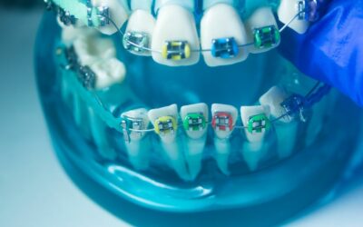 Diferencia entre brackets metálicos y cerámicos