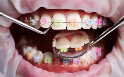 Blog De Ortodoncía En Panamá 3 Duración Ideal para Elásticos Intermaxilares