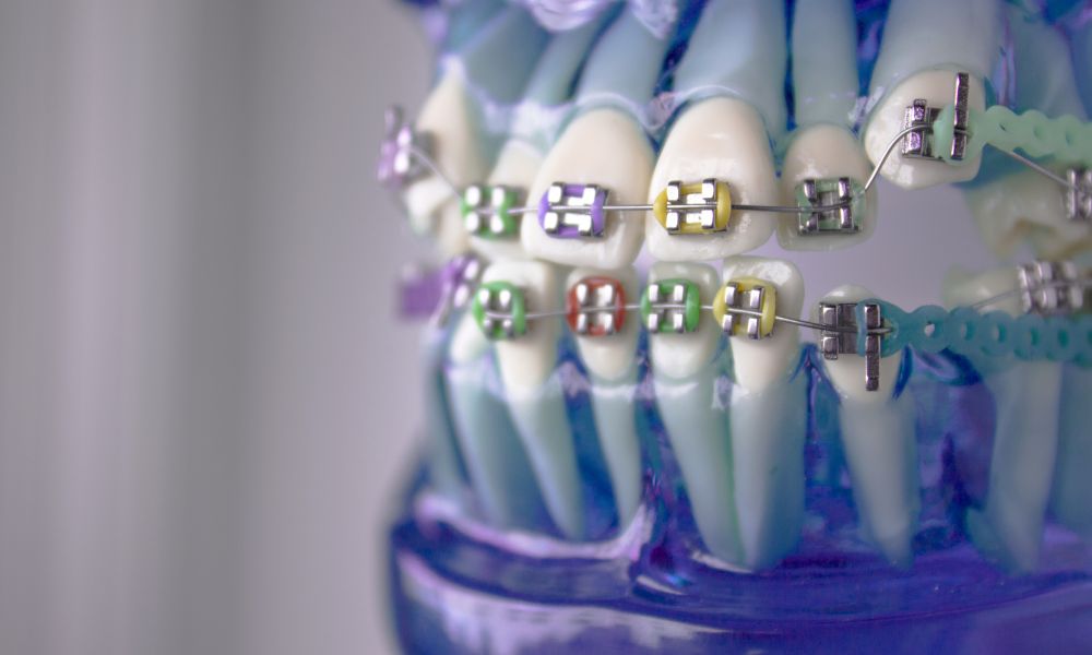 Ortodoncia Acelerada Con Microimplantes: ¿Cómo Funciona? 1 El Anclaje Esquelético Revolucionando la Ortodoncia