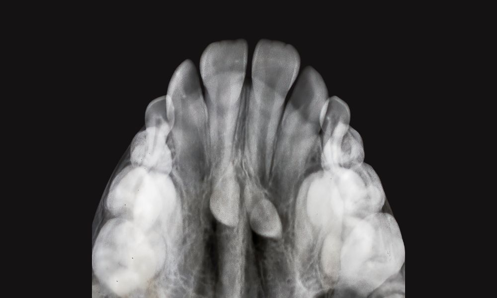 Soluciones Efectivas Para Paladar Estrecho 1 Importancia de abordar el paladar estrecho a tiempo