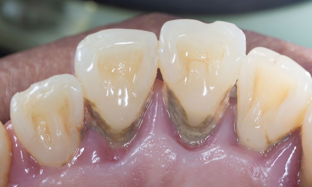 Importancia del tratamiento periodontal antes de la ortodoncia
