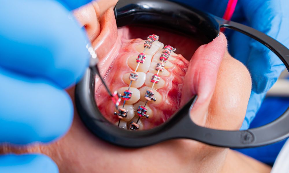 Alternativas a los brackets tradicionales