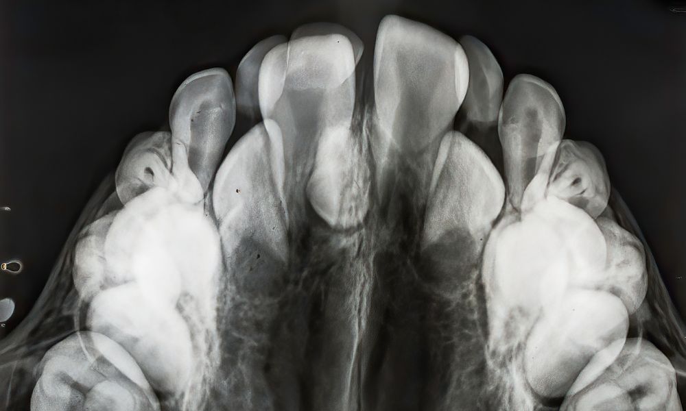 Causas y Diagnóstico de la Hiperdoncia