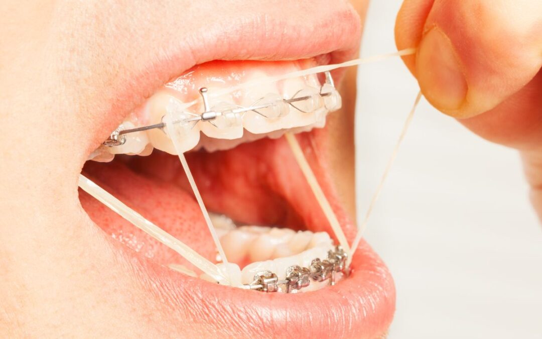 Duele ponerse brackets: Causas y soluciones en Panamá