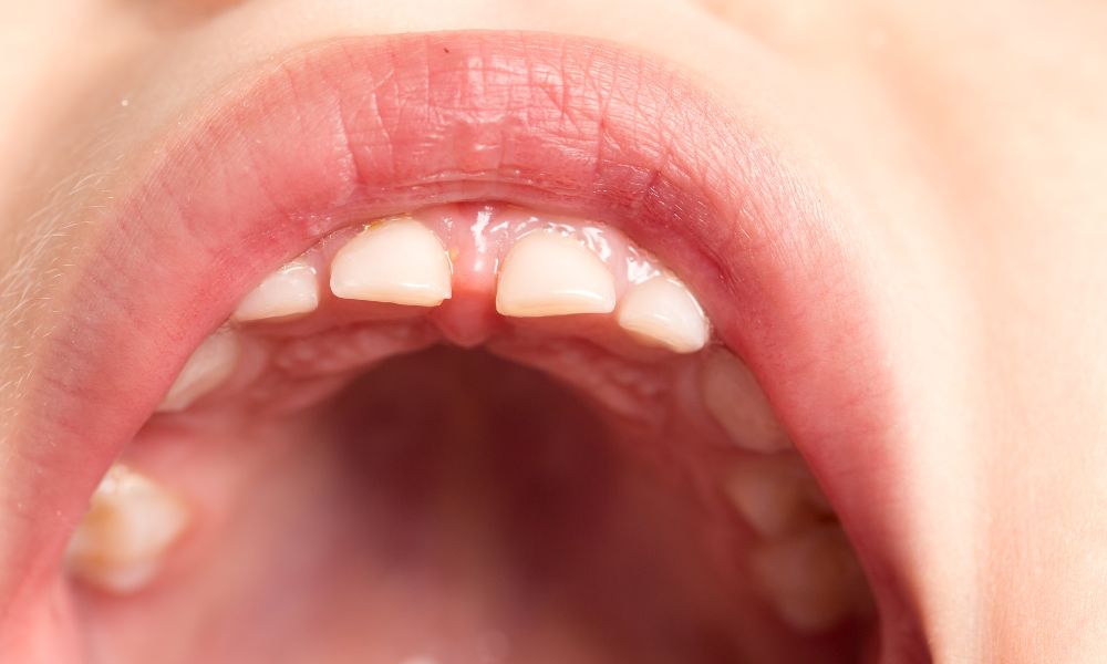 Guía Sobre Microdoncia: Tratamientos Y Beneficios En Panamá 1 Entendiendo la Microdoncia Definición y Características
