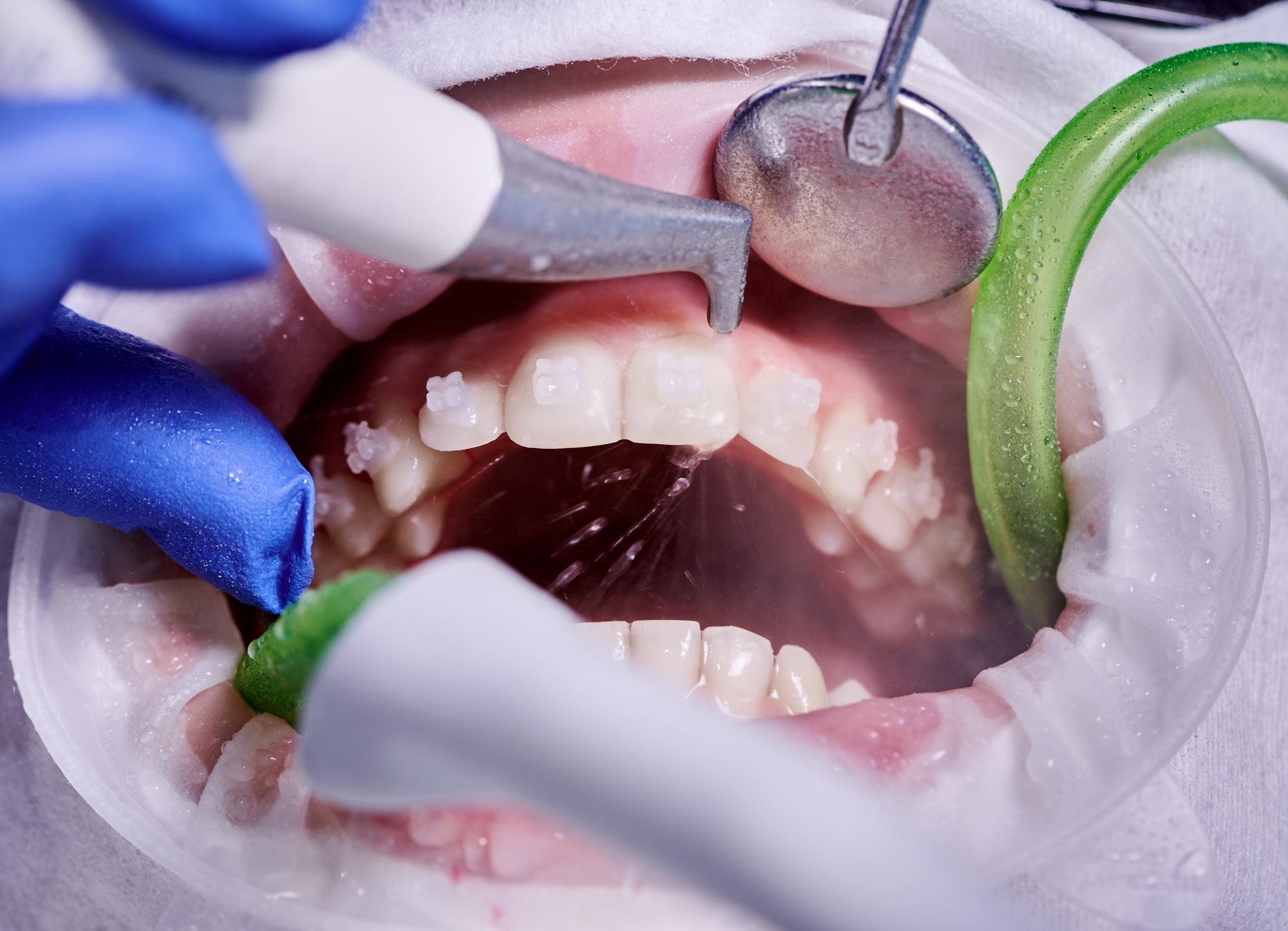 Qué no hacer después de una limpieza dental: Guía práctica