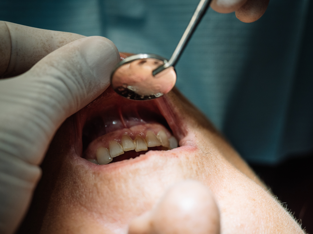 Causas que Provocan Hematomas en las Encías
