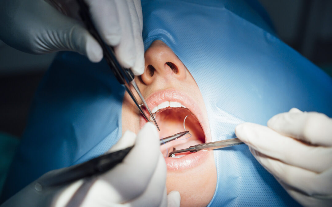 ¿Cuánto Dura el Dolor Después de una Exodoncia?