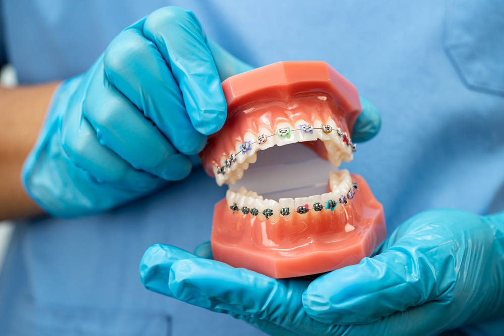 Ortodoncia Preventiva Y Correctiva: Entendiendo Sus Diferencias Y Beneficios 1 Ortodoncia Preventiva y Correctiva Tu Camino hacia una Sonrisa Saludable