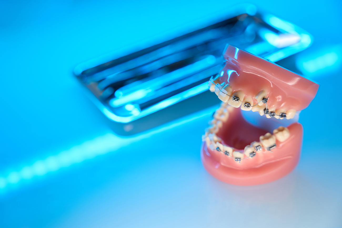 Ortodoncia Preventiva Y Correctiva: Entendiendo Sus Diferencias Y Beneficios 2 Preguntas Frecuentes sobre Ortodoncia