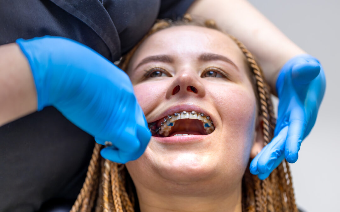 Estabilización después de tratamiento ortodóntico: claves para mantener tu sonrisa