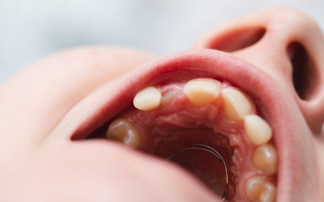 Hipomineralización Incisivo Molar: Causas y Tratamientos