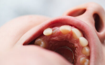 Blog De Ortodoncía En Panamá 5 Hipomineralización Incisivo Molar: Causas y Tratamientos