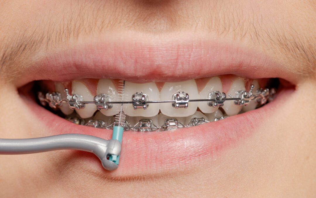 Los Brackets de Autoligado No Llevan Ligas: Sistema Innovador