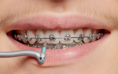 Blog De Ortodoncía En Panamá 2 Los Brackets de Autoligado No Llevan Ligas: Sistema Innovador