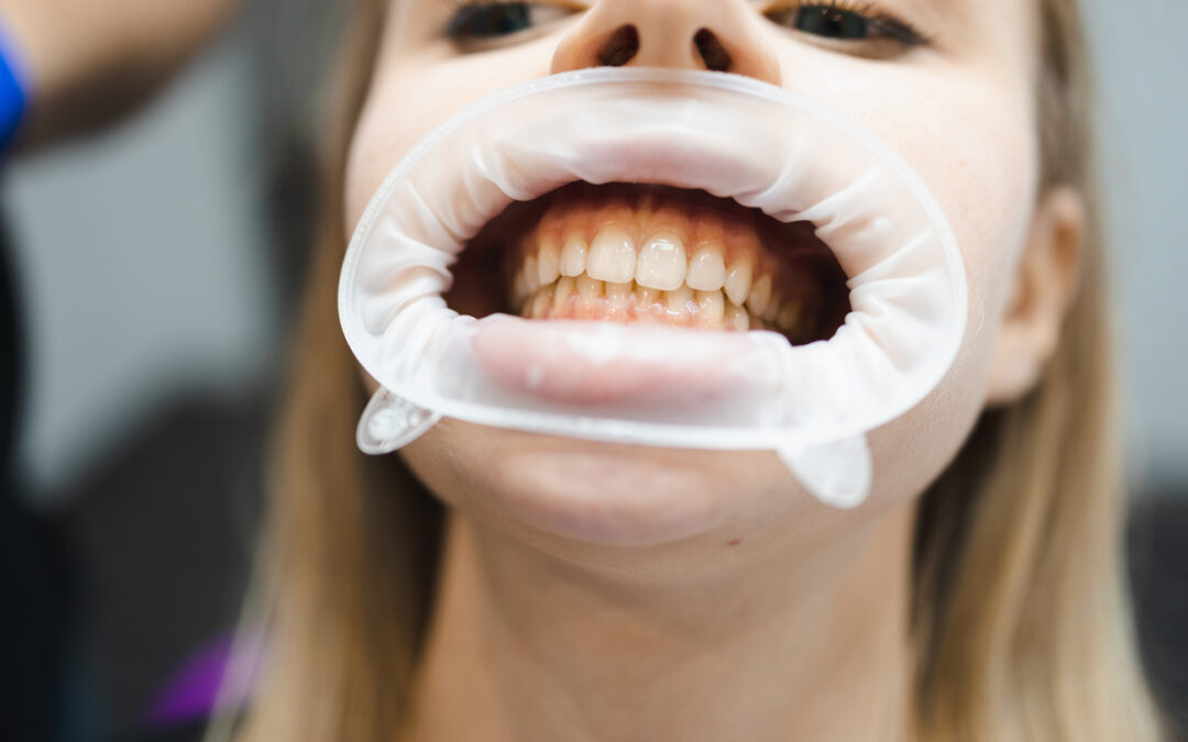 ¿Se pueden blanquear todos los dientes? Limitaciones reales