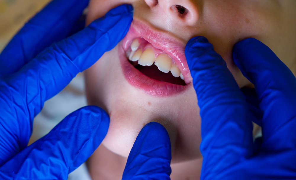 Comprendiendo el Apiñamiento Dental