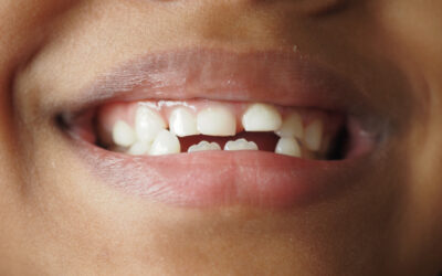 Los dientes apiñados causan caries: riesgos y consecuencias