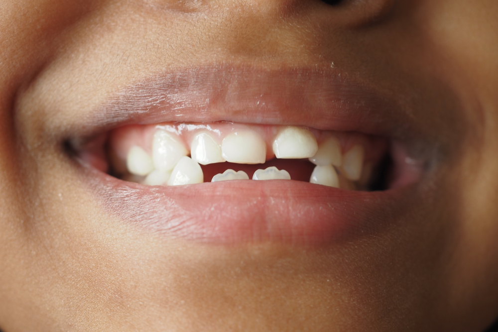 Los dientes apiñados causan caries: riesgos y consecuencias