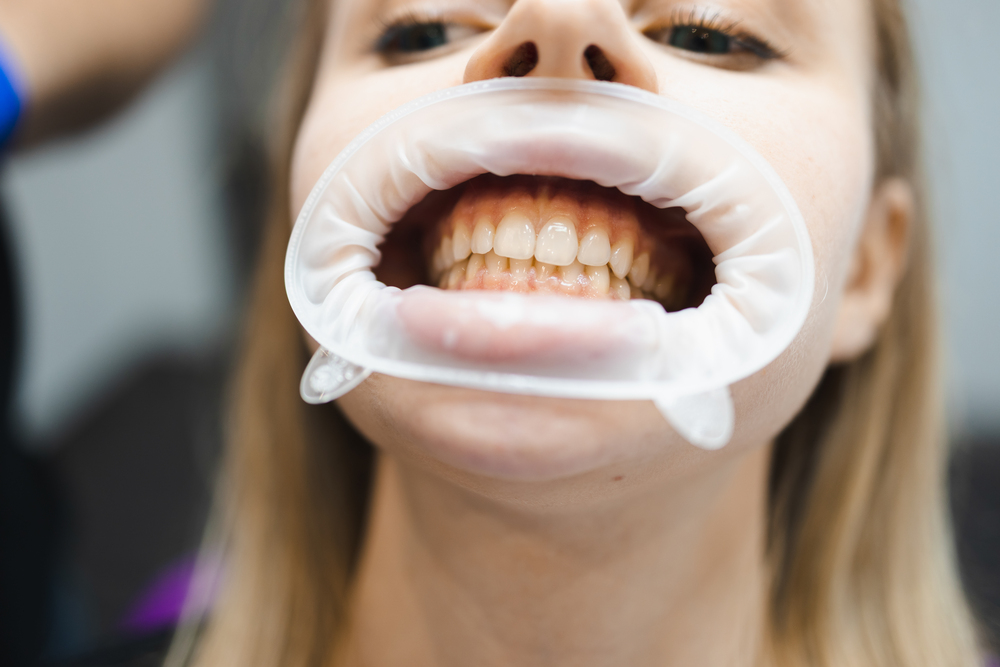 ¿Qué No Hacer Después de un Blanqueamiento Dental?