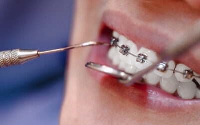Qué Cepillo Usar para Brackets: Guía Dental Especializada