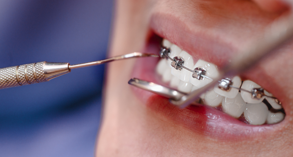 Qué Cepillo Usar para Brackets: Guía Dental Especializada