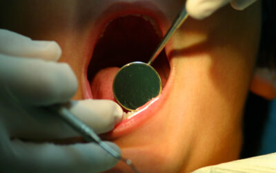 Se Me Hizo un Hueco en el Diente: Causas y Soluciones