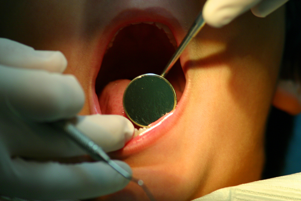 Se Me Hizo un Hueco en el Diente: Causas y Soluciones