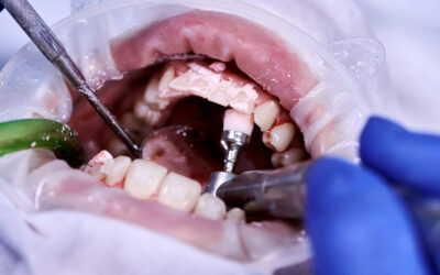 Mantenimiento Periodontal: Qué Es y Sus Beneficios