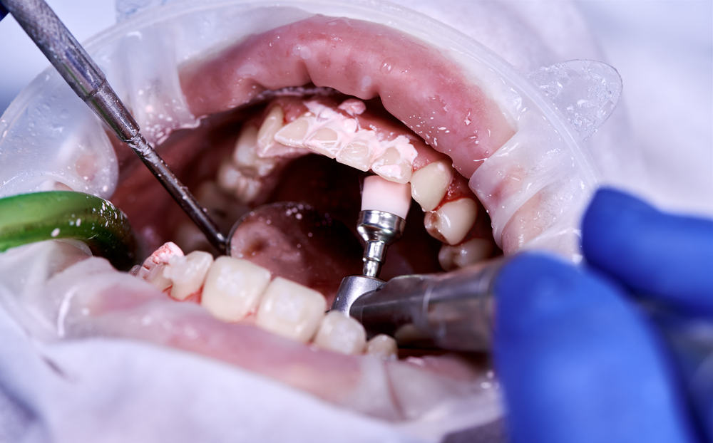 Mantenimiento Periodontal: Qué Es y Sus Beneficios