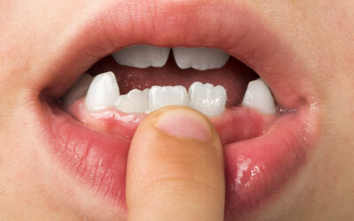 Diastema por Frenillo: Causas y Tratamientos Efectivos